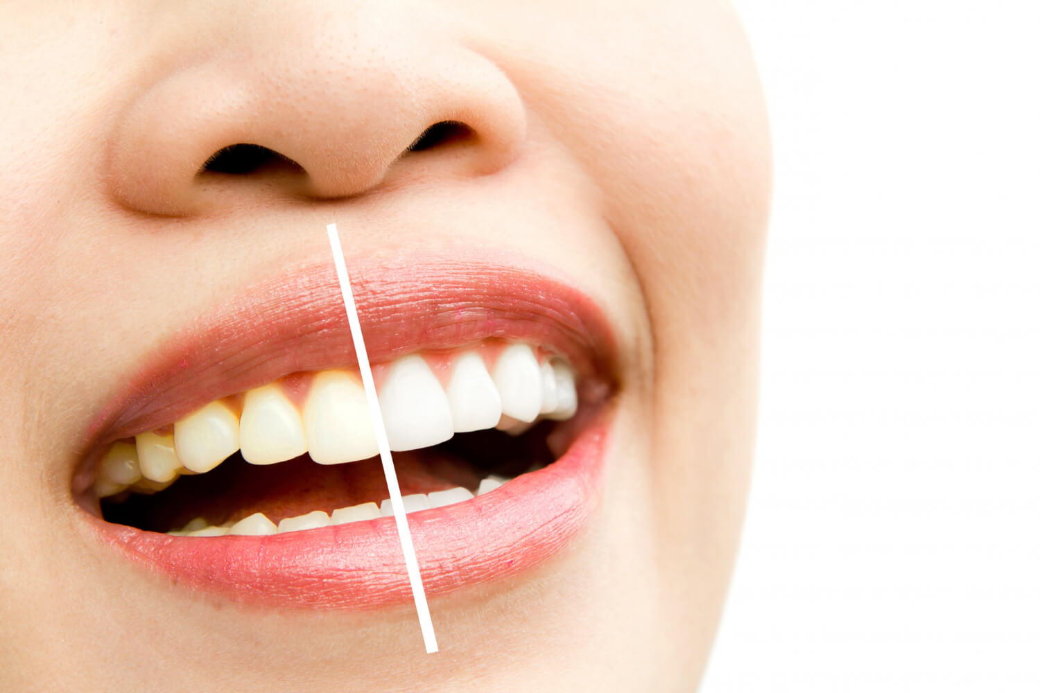 Clareamento dental Caxias do Sul